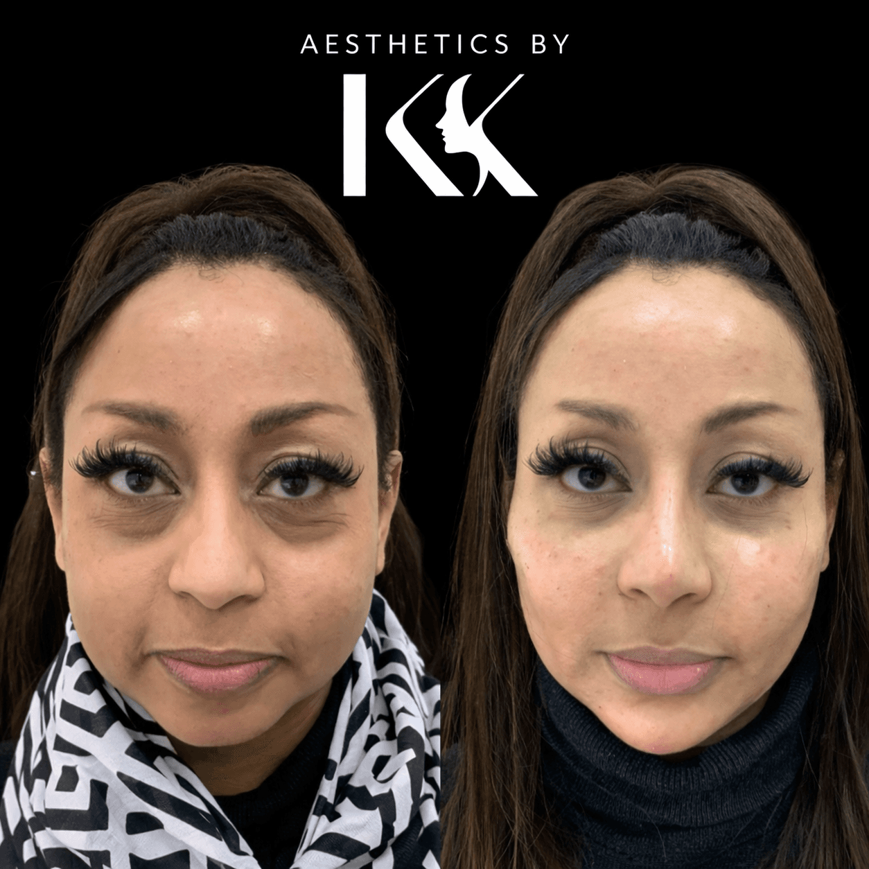Aesthetic transformation before and after at Aesthetics by KK