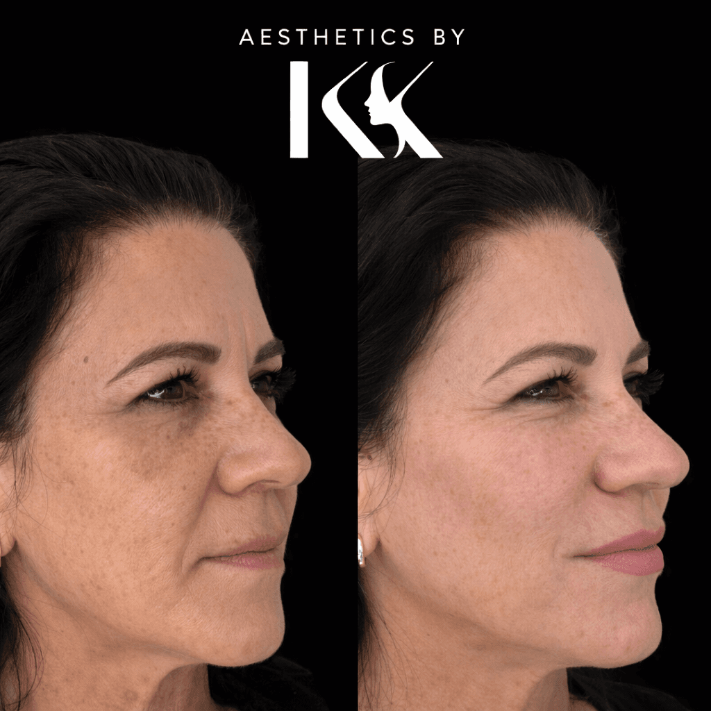 Before and after skin transformation at Aesthetics by KK