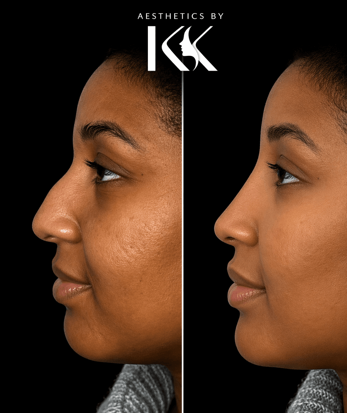 Regenerative aesthetic treatment results at Aesthetics by KK