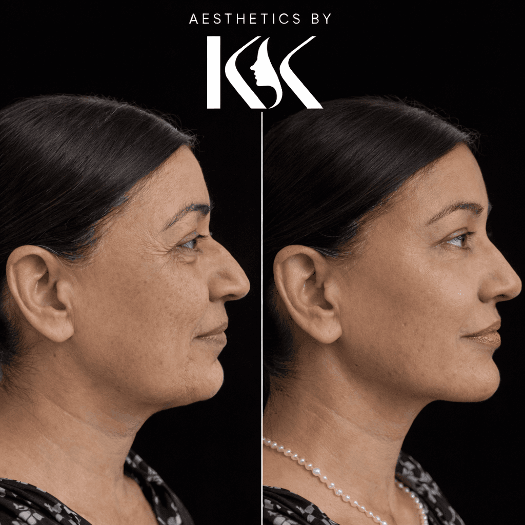 Injectable treatment results at Aesthetics by KK