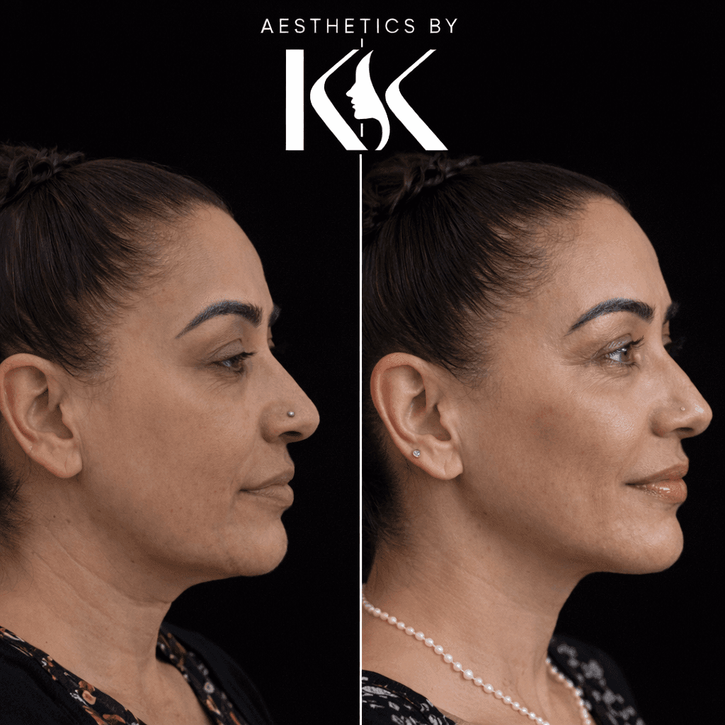 Anti-wrinkle treatment results at Aesthetics by KK