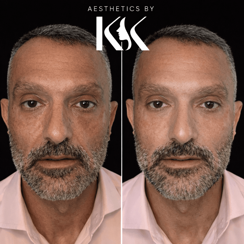 Natural-looking filler results at Aesthetics by KK