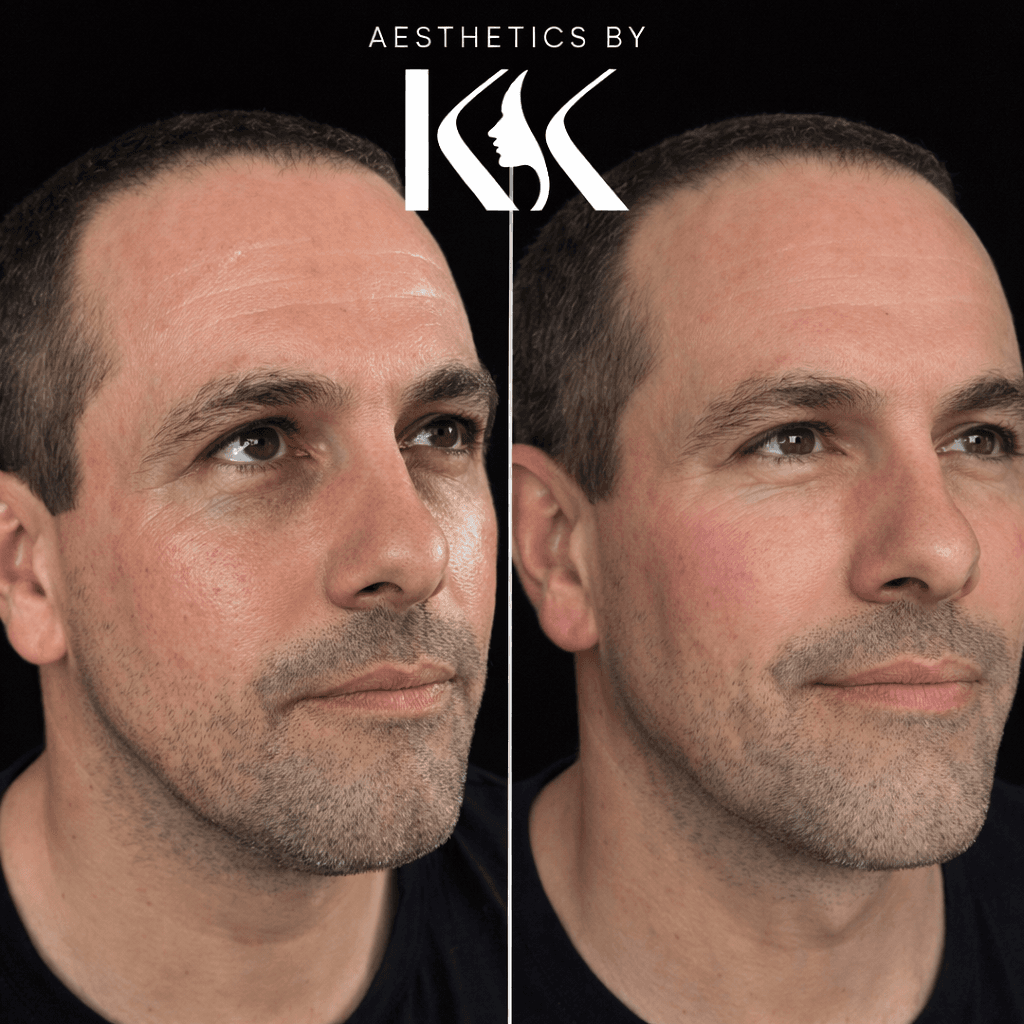 Profile balancing treatment results at Aesthetics by KK