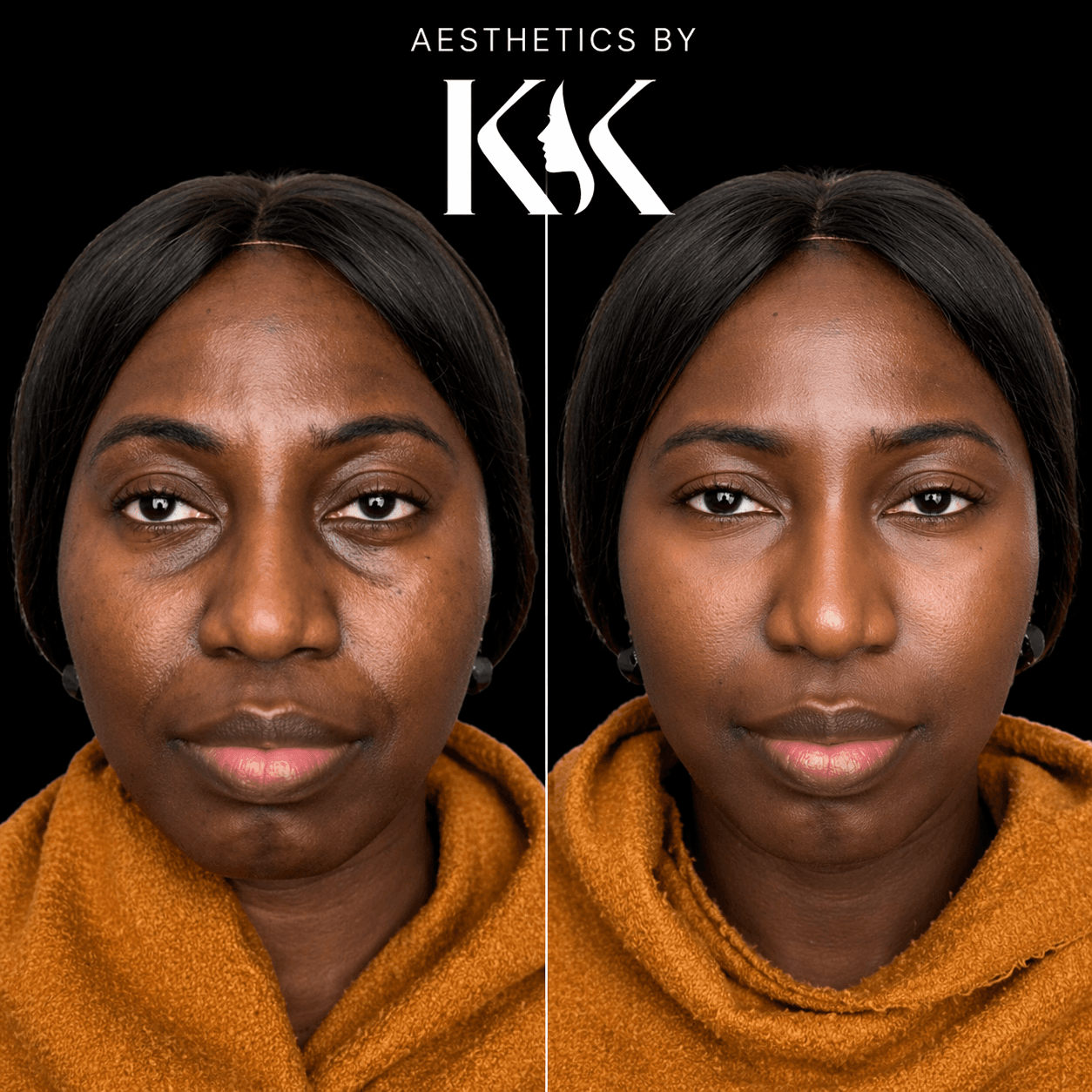 Cheek and midface rejuvenation at Aesthetics by KK