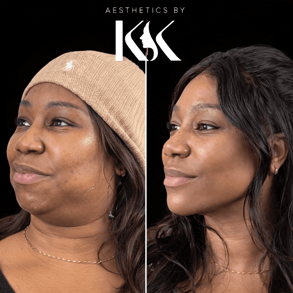 Under-eye and tear trough treatment results at Aesthetics by KK