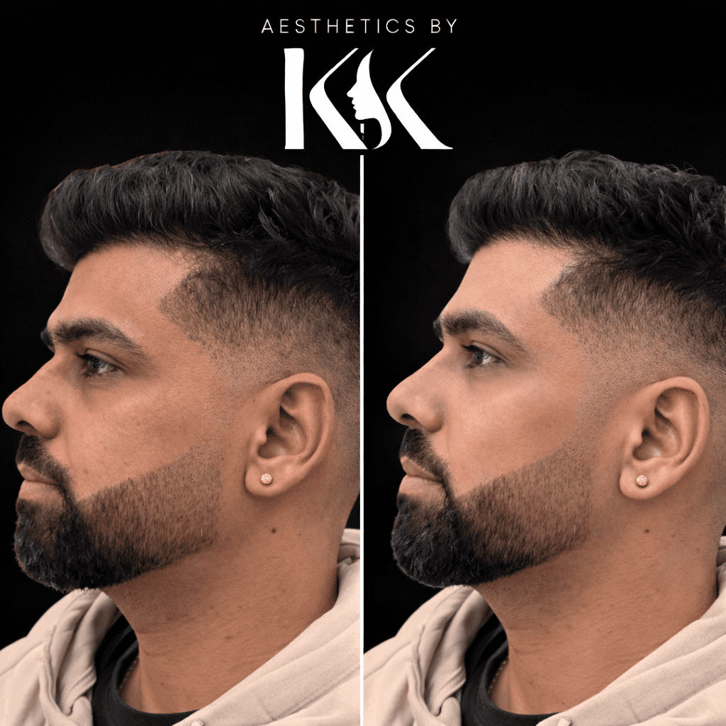 Jawline definition treatment results at Aesthetics by KK