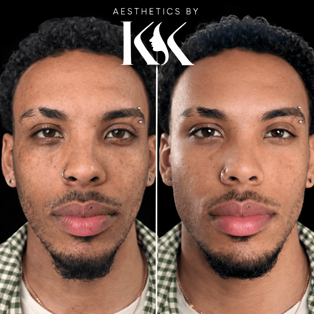 Skin texture improvement at Aesthetics by KK