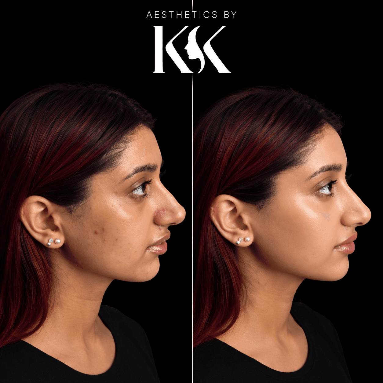 Glow and hydration treatment results at Aesthetics by KK