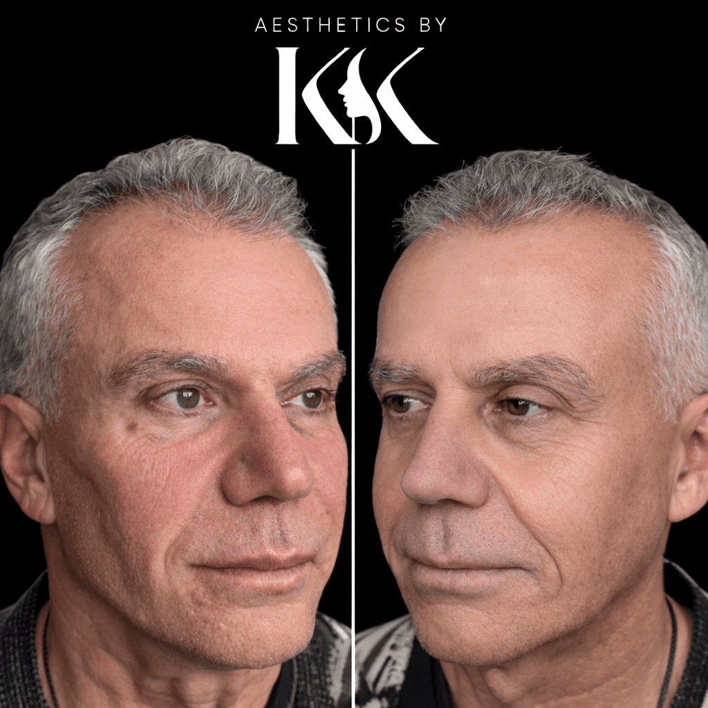 London and Birmingham clinic treatment results at Aesthetics by KK