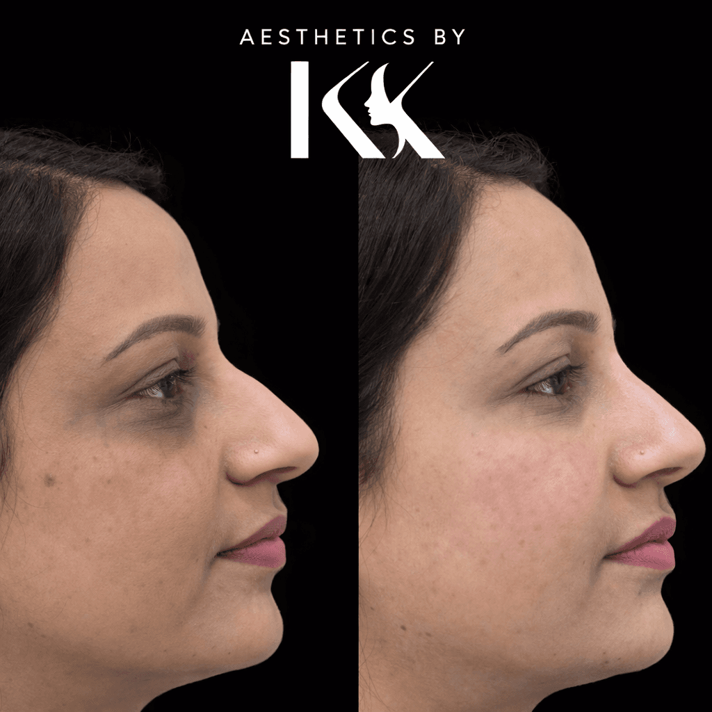 Cosmetic transformation before and after at Aesthetics by KK