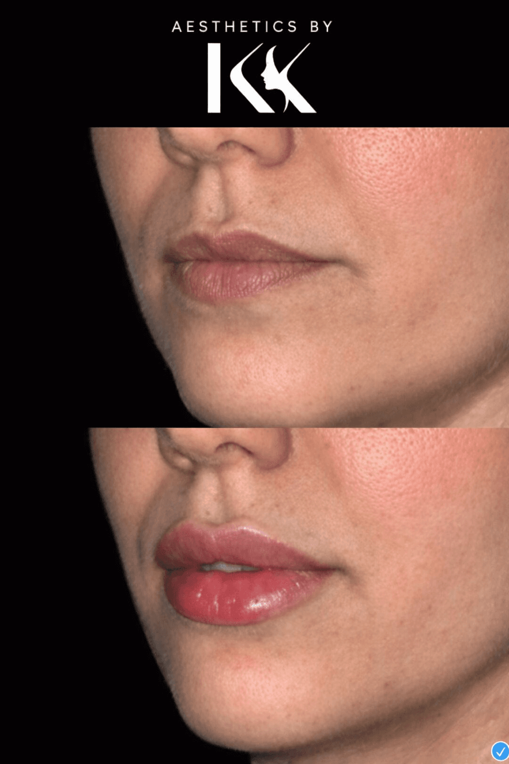 Lip enhancement comparison at Aesthetics by KK