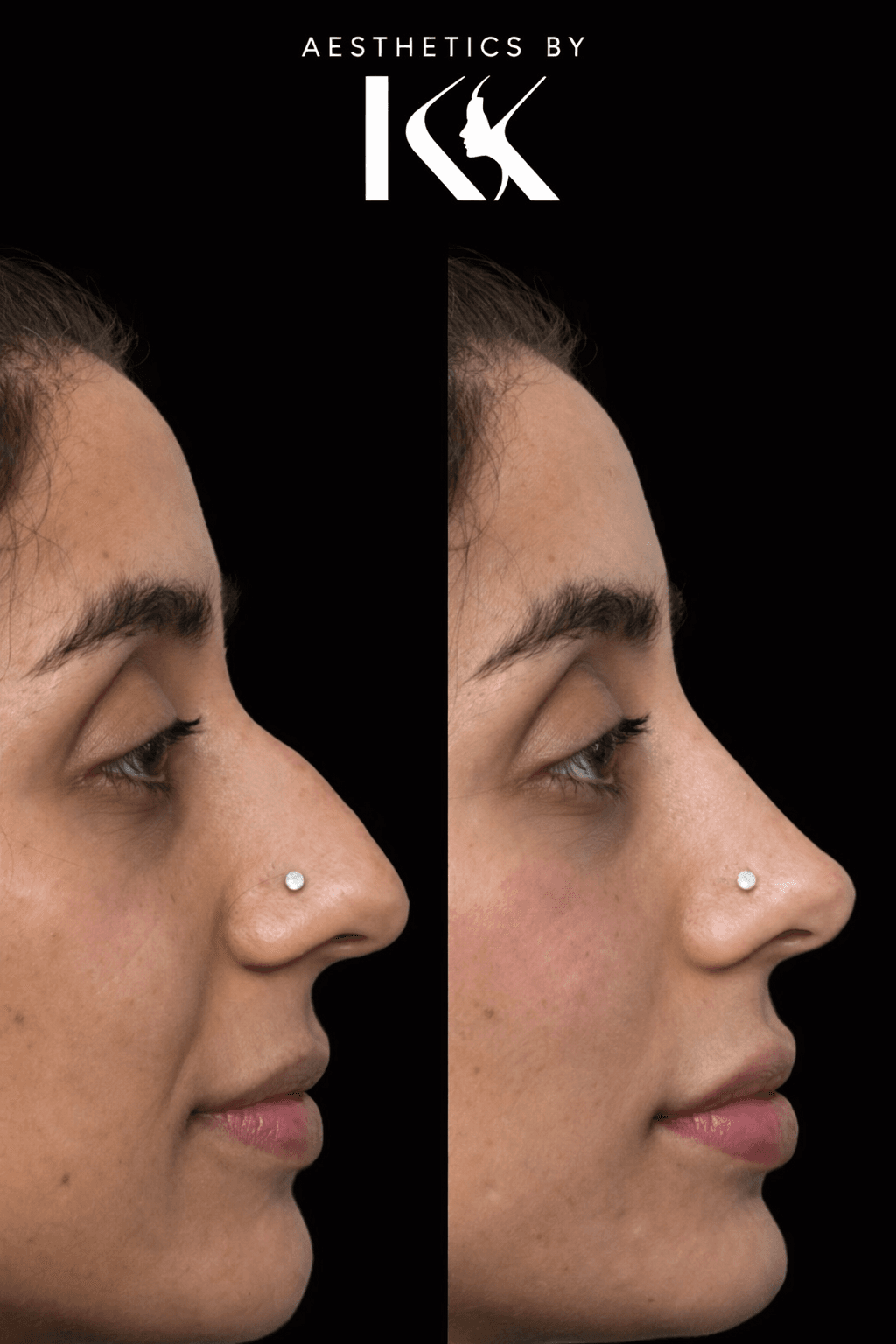 Nose transformation side-by-side comparison at Aesthetics by KK