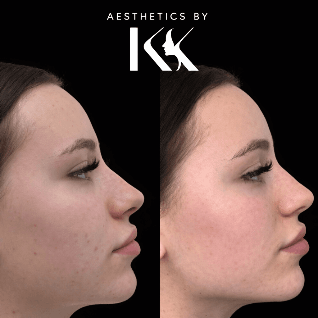 Skin transformation profile comparison at Aesthetics by KK